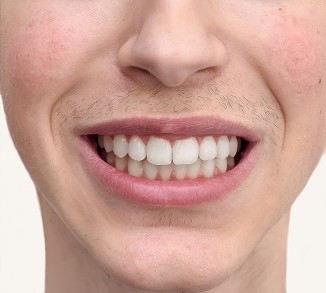 teeth before and after braces