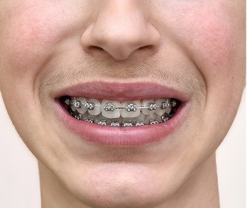 teeth before and after braces